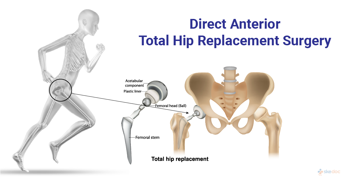 Direct Anterior Total Hip Replacement