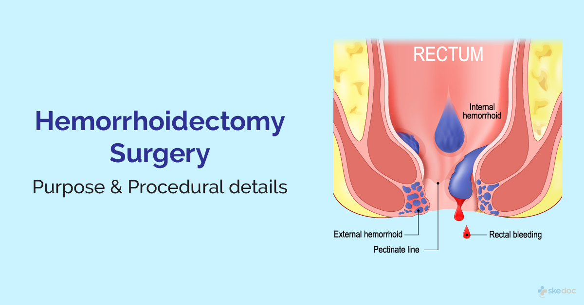 Haemorrhoidectomy