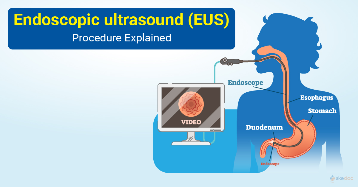 Endoscopic UltraSound