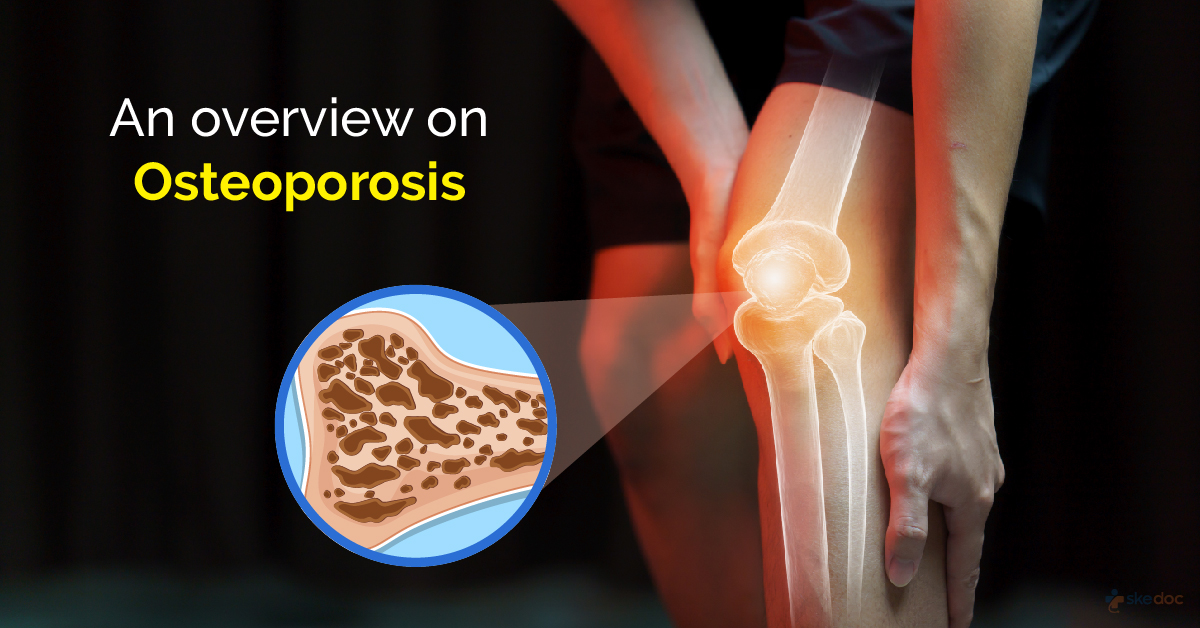 An Overview On Osteoporosis